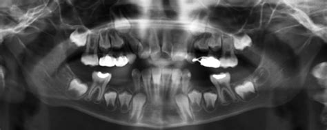 Pre Treatment Radiographs A Periapical Radiograph Of The Maxillary