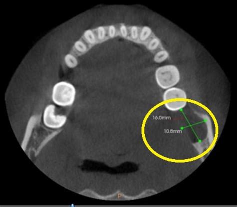 Intraosseous Mucoepidermoid Carcinoma Of Mandible A Rare Case Presentation And Literature