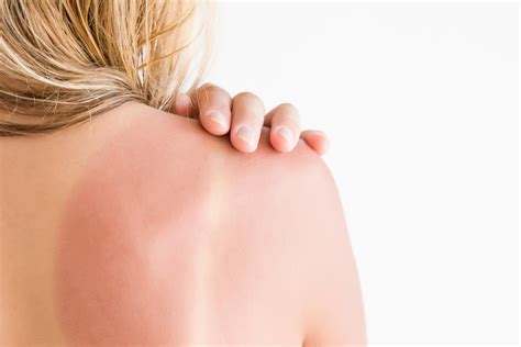 Macchie Solari Sul Corpo Cause E Rimedi Naturali