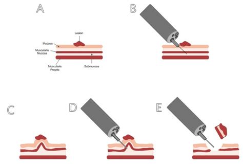 Dr Arvind Trindade Endoscopic Resection