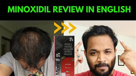 Minoxidil Review In English Minoxidil Result Before After