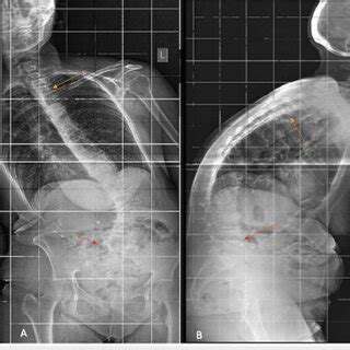 Postoperative Anteroposterior A And Lateral B Radiographs The