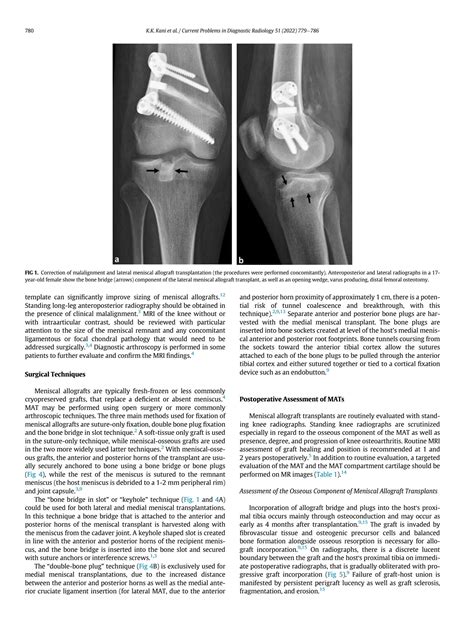 Solution Meniscal Allograft Transplantation A Pictorial Review Studypool