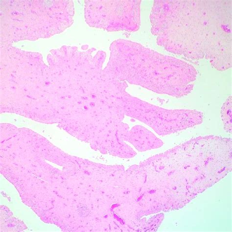 Fibroepithelial Polyp Consisting Of A Fibrovascular Core And A Covering