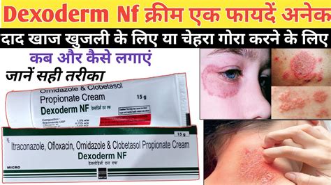 Dexoderm Nf Dexoderm Nf Cream Ke Fayde Dexoderm Oc Plus Cream Dexoderm Nf Cream Fourderm