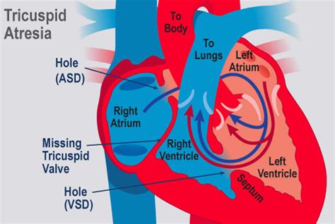 Tricuspid atresia causes, symptoms, diagnosis, treatment & prognosis