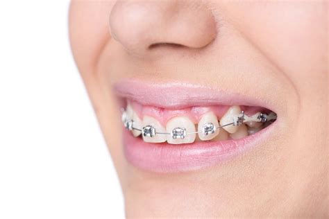 6 Benefits of Invisalign Braces over Traditional Braces for Cosmetic Dentistry - Aussie Trade