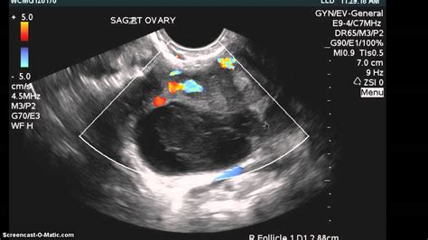 Hemorrhagic Cyst And Endometrioma Same Ovary Youtube