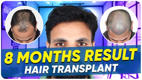 Hair Transplant In Mysore Best Results And Cost Of Hair Transplant In