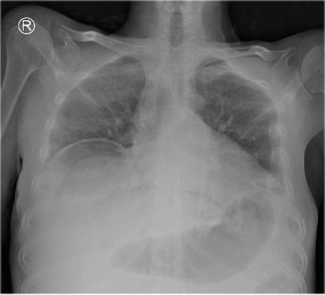 Chest-X-ray showing air under diaphragm. | Download Scientific Diagram