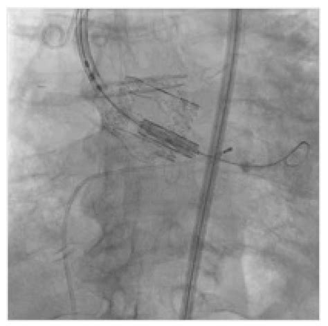 Jcm Free Full Text Transcatheter Aortic Valve Replacement In