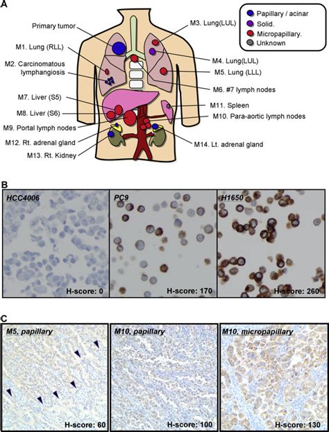 Heterogeneity Of Egfr Aberrations And Correlation With Histological