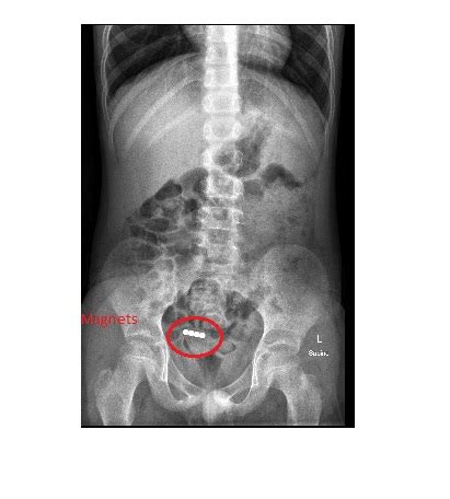 Imaging Case Of The Week 455 Answer Emergucate