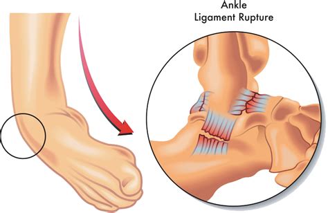 Ankle And Foot Injuries Templeton Dr William Sima Md