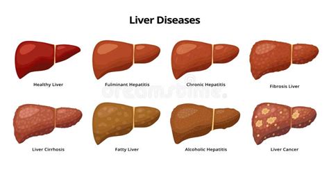 Stages of Liver Damage from Healthy, Fatty Liver, Fibrosis, Cirrhosis To Liver Cancer. Medical ...