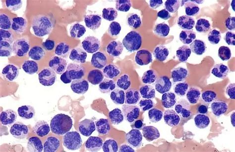 Leukemoid reactions in children: types (kinds), causes, diagnostic algorithm, treatment ...