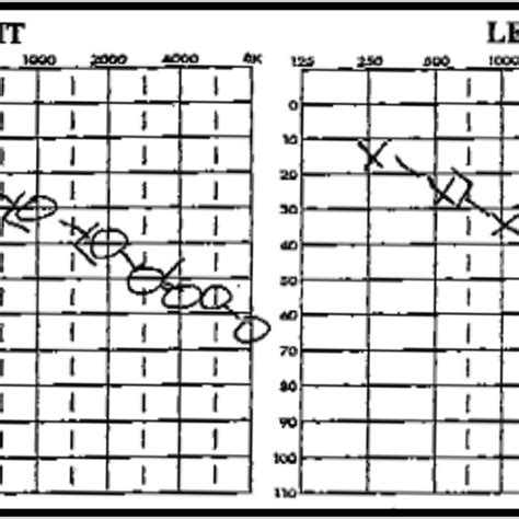 An audiogram demonstrating an approximately 80 decibel (dB) drop from ...