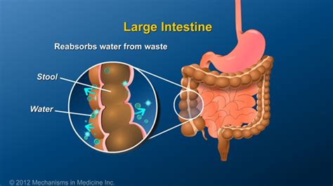 Slide Show What Is An Ileostomy