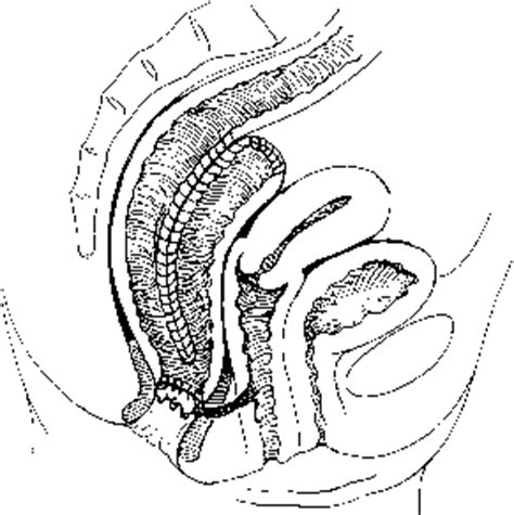 Vaginal Rectovaginal Fistulas Repair Treatment Colorectal Jcm