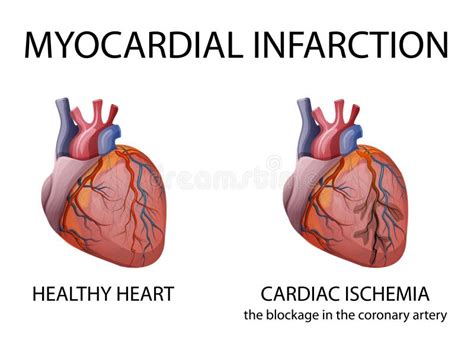 Infarkt Stock Illustrationer Vektorer Clipart Stock