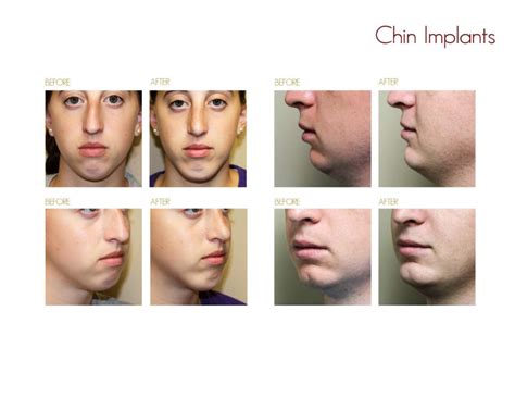 Chin Implants Drake And Presti Ent Surgical Associates