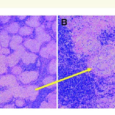 Patient slides of mediastinal lymph node biopsy. Low-(A) and high-power ...