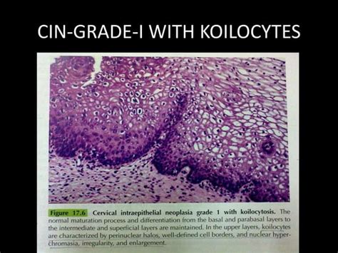 Cervical Intraepithelial Neoplasia Ppt