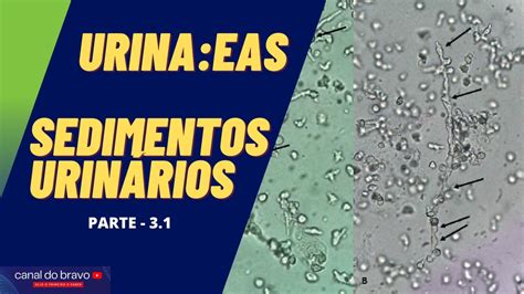 URINA EAS NA PRÁTICA SEDIMENTOSCOPIA URINÁRIA PARTE 3 1 YouTube