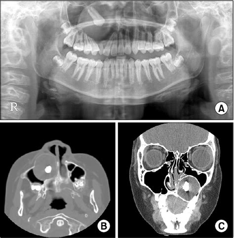 Initial Panoramic Radiograph Showing A Radiolucent Lesion Associated