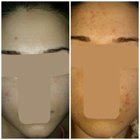 Sudden acne flare up. Fungal acne? : acne
