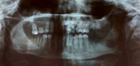 Orthopantomogram OPG Showing Multilocular Radiolucency In All 4