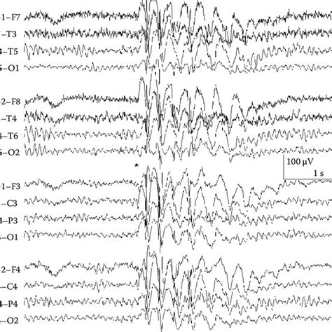 A Burst Of Generalized Hz Spike And Wave Activity Primary