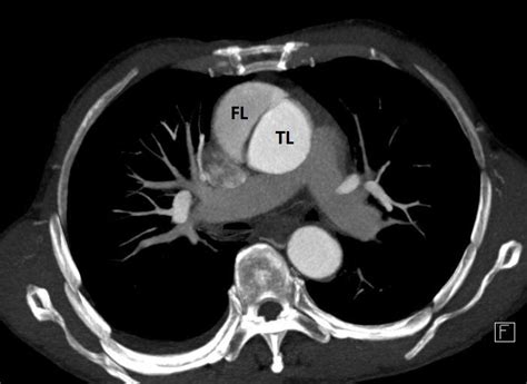 Ascending Aortic Dissection