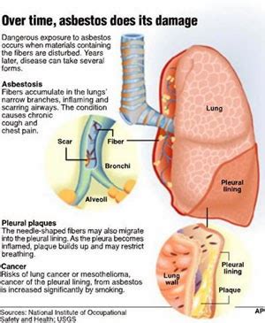 Mesothelioma - The Stages of Pleural Mesothelioma | - Blog Hanz