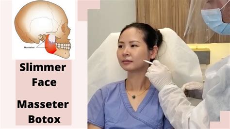 Botox Injections To Masseter Muscles How To Get Slimmer Face Youtube