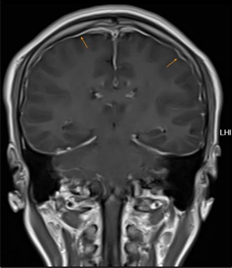 Contrast-enhanced brain MRI demonstrating smooth diffuse pachymeningeal ...