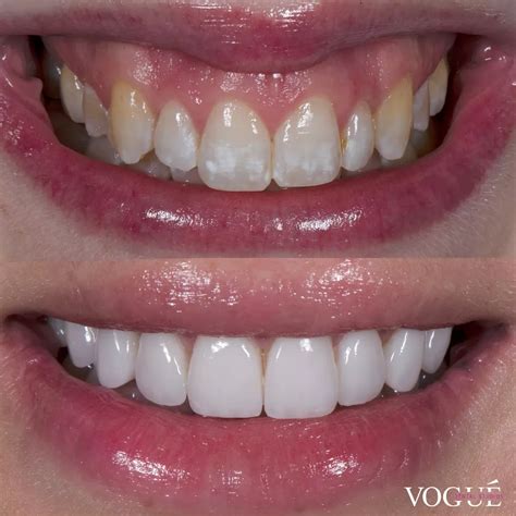 Veneers before and after – Artofit