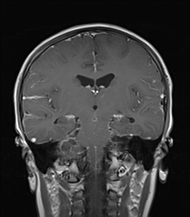 Tuberculous Meningitis Image Radiopaedia Org