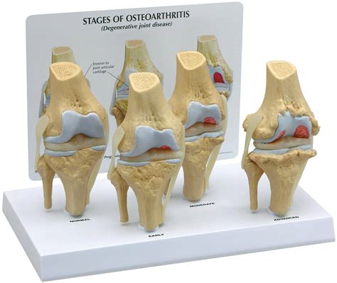4-Stage Osteoarthritis Knee Model GPI 1100