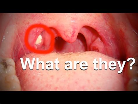 What Can Cause White Spots On Your Throat