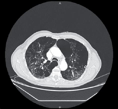 Emphysema dominant COPD. | Download Scientific Diagram