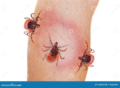 Tick On Human Leg Dangerous Parasite On Human Skin Stock Photo