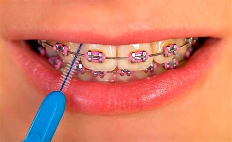 Braces Inside Out