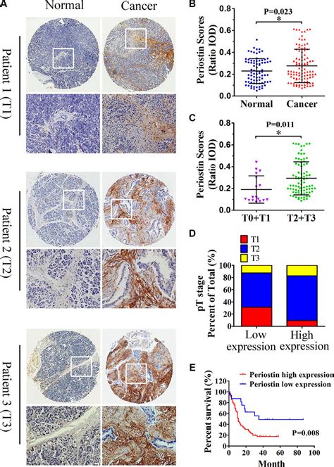 Increased periostin expression correlates with pancreatic cancer ...