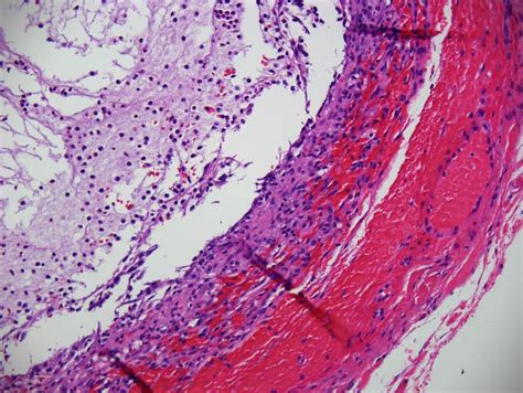 Salivary Gland Mucocele Mucoocele Dermatology Advisor