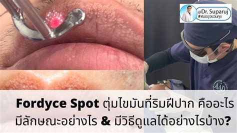 Fordyce Spot ตุ่มไขมันที่ริมฝีปาก คืออะไร มีลักษณะอย่างไร And มีวิธีดูแลได้อย่างไรบ้าง Youtube