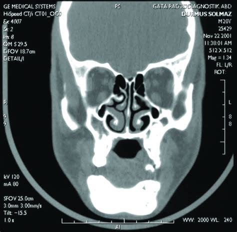 F Multiple Impacted Teeth Report Of Cases Open I