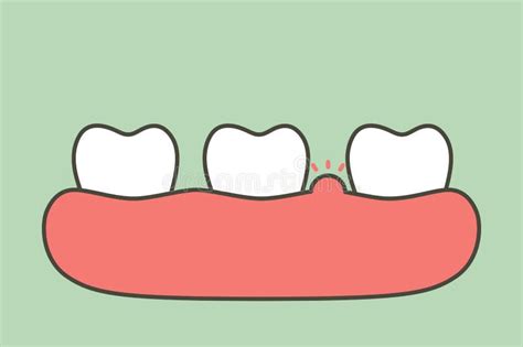 Periodontitis Or Gum Disease With Swell Teeth Cartoon Vector Flat