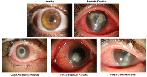 From The Diagnosis Of Infectious Keratitis To Discriminating Fungal