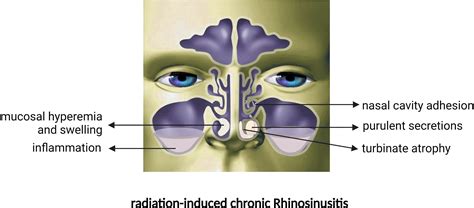 Frontiers Impairment Mechanism Of Nasal Mucosa After Radiotherapy For